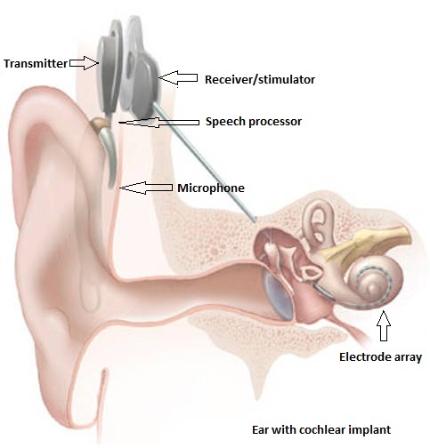 cochlear implant